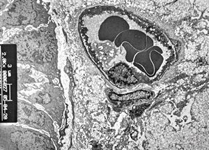 jejunum … lipid malabsorption